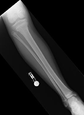 PACSWeb image of a human bone