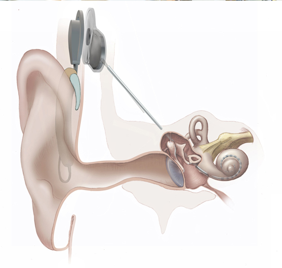 cochlear implant