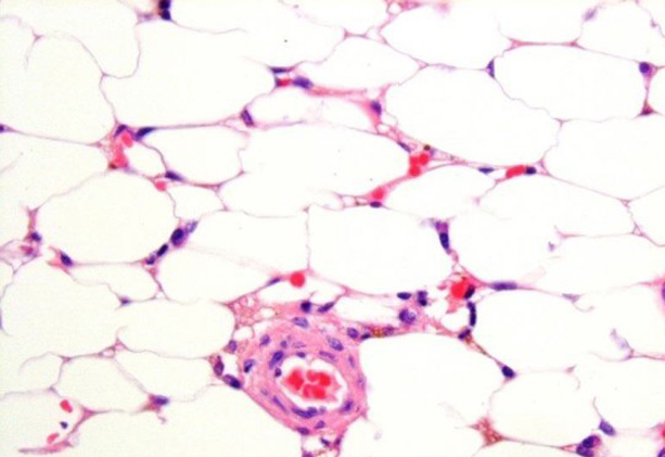 aplastic anemia