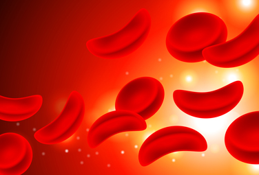 Medical illustration displaying disc-shaped normal red blood cells and rigid, C-shaped sickle cells