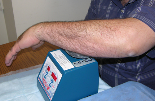 a male patient with vibratory urticaria displaying itchy red welts on his arm