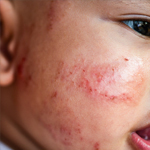 close-up of eczema on a baby's cheek