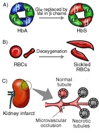 sickle cell and kidney flowchart