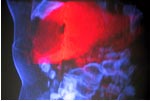 Holographic Globe - 3D spatial visualization moves beyond regular display monitors to show inside the body during procedures. The colon is blue, the liver is red, and there is a hole in the liver where a tumor was cooked with needles in a minimally-invasive, image-guided procedure